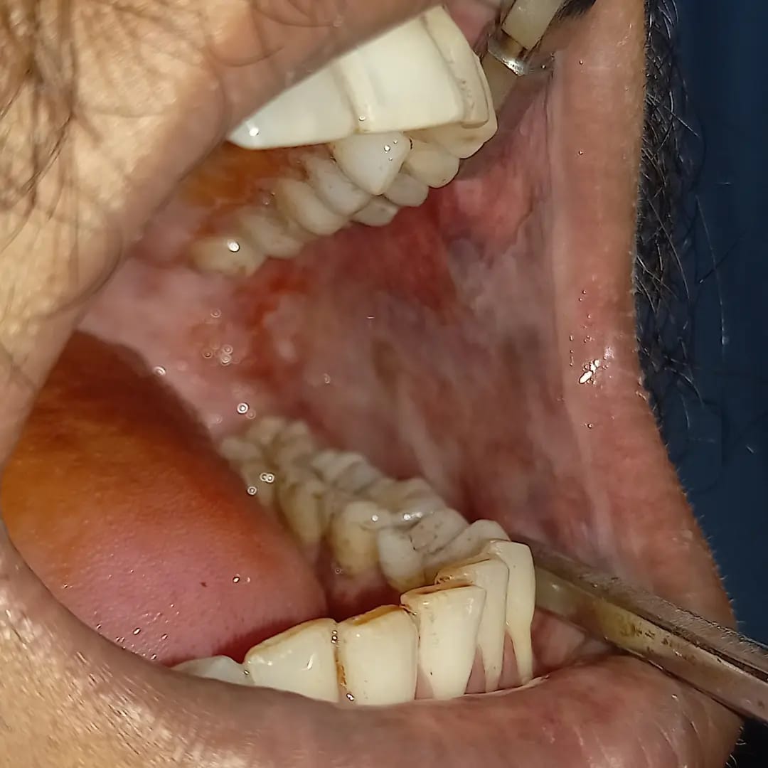 Oral Pre Cancer and Oral Cancer Screening
